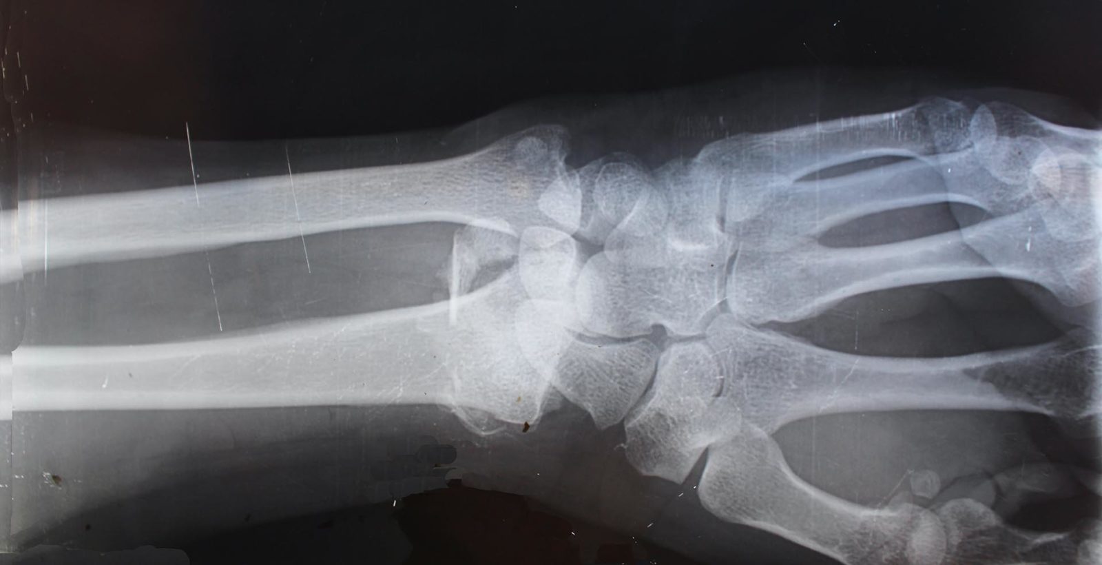 x-ray of a human wrist